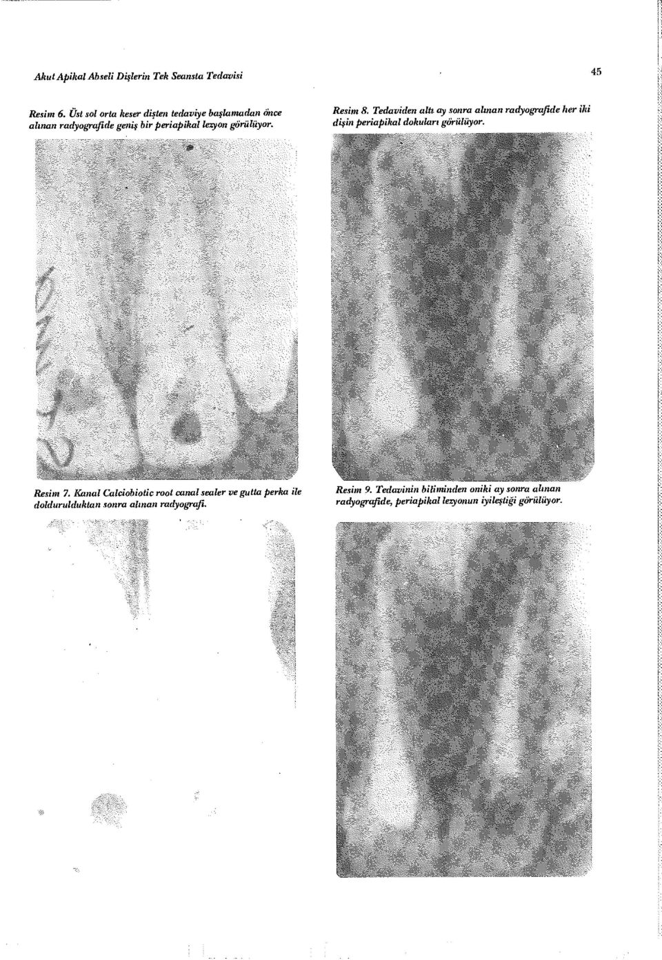 Tedaviden alti ay sonra alınan radyografide dişin periapihal dokuları görülüyor. Resim 7.