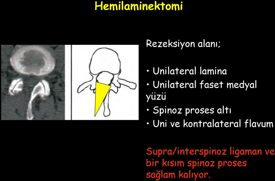 proses altı Uni ve kontralateral flavum