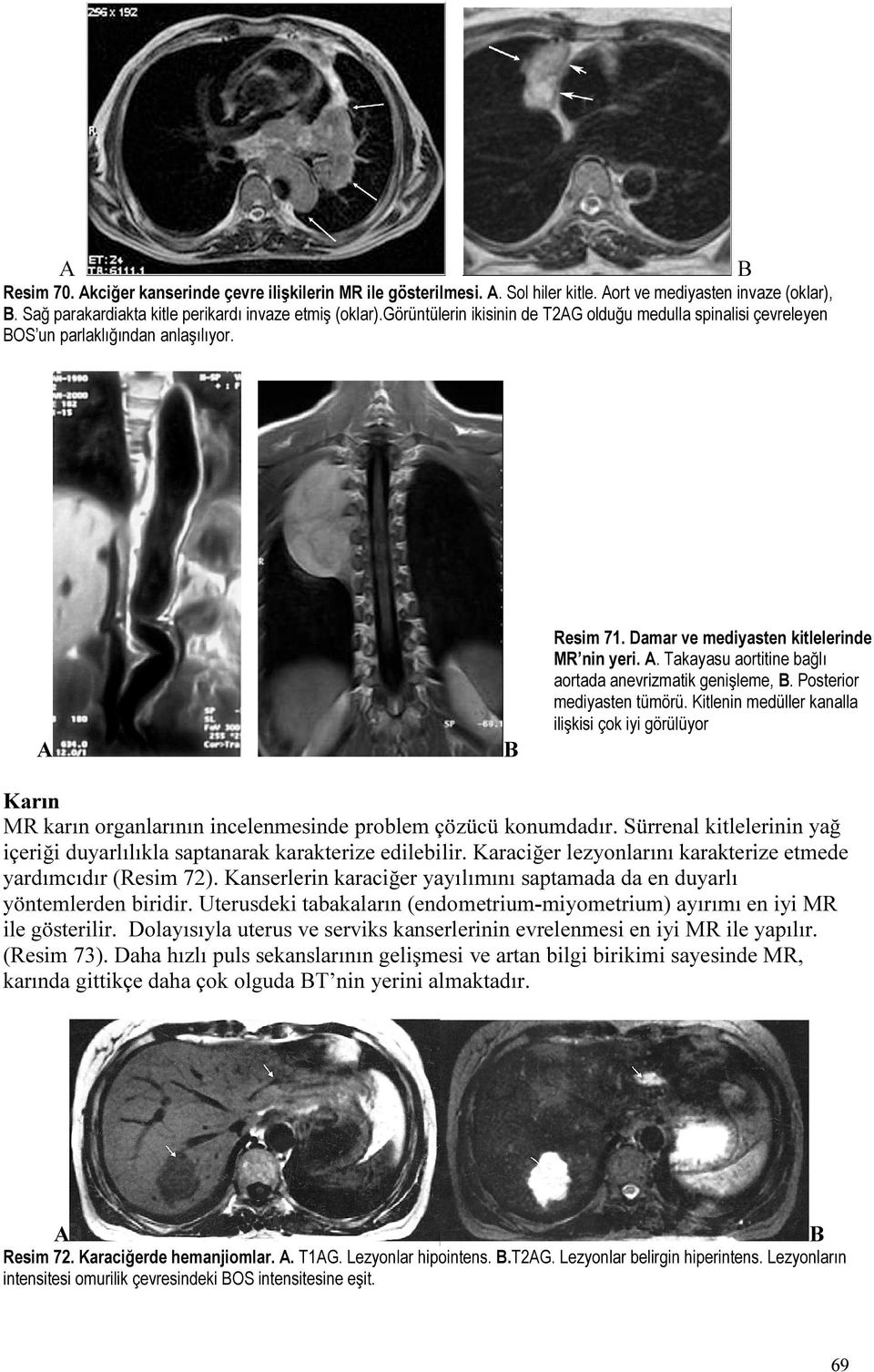 . Takayasu aortitine bağlı aortada anevrizmatik genişleme,. Posterior mediyasten tümörü.