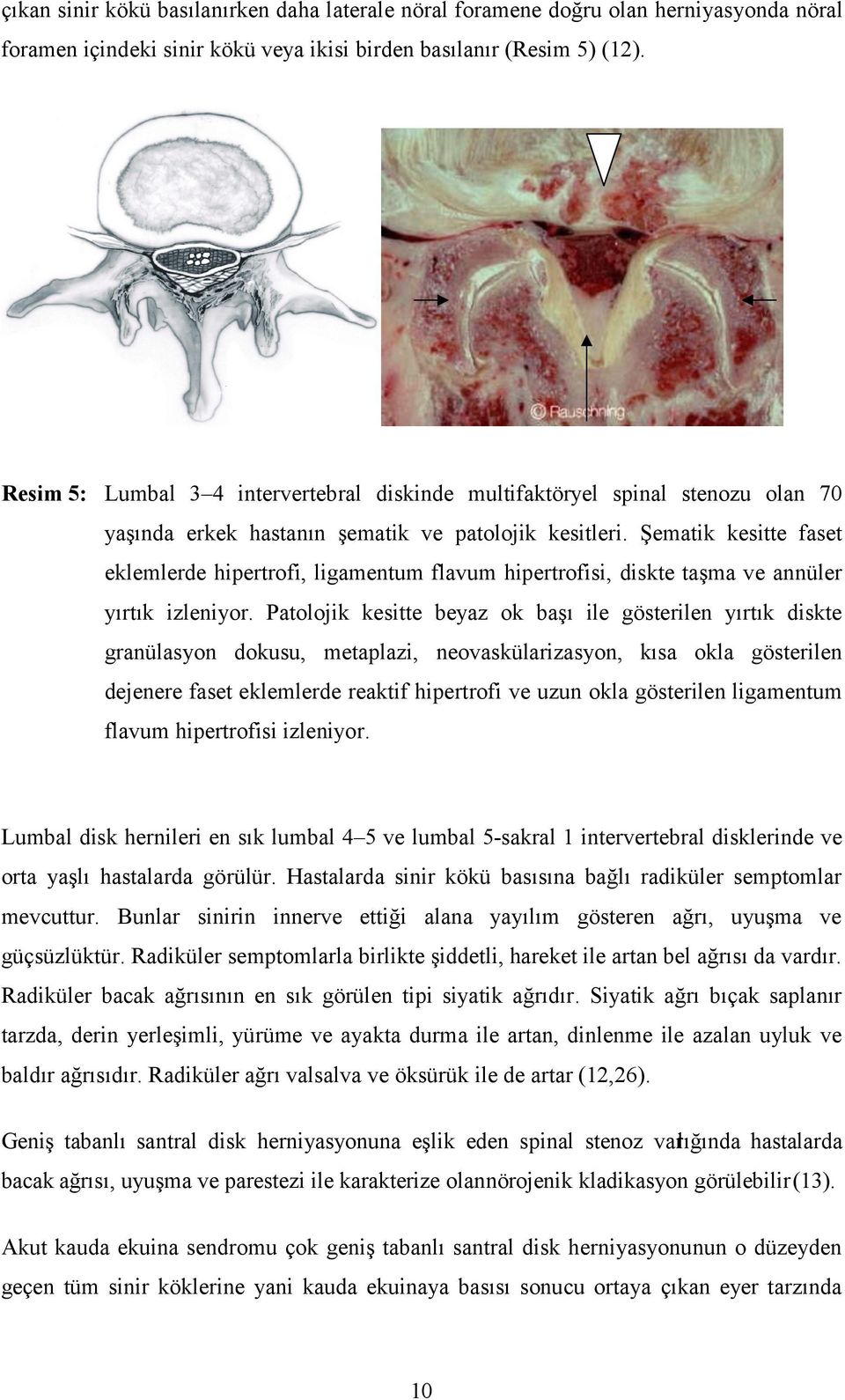 Şematik kesitte faset eklemlerde hipertrofi, ligamentum flavum hipertrofisi, diskte taşma ve annüler yırtık izleniyor.