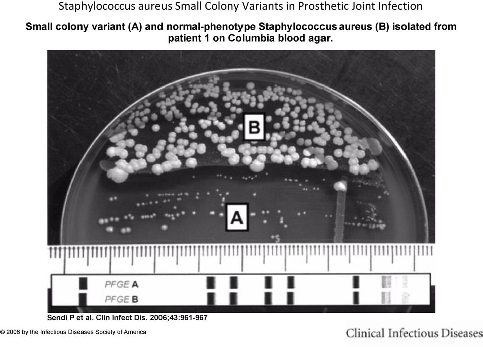 aureus (B) isolated from patient 1 on Columbia blood agar. Sendi P et al.