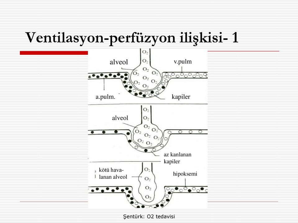 pulm. kapiler alveol kötü