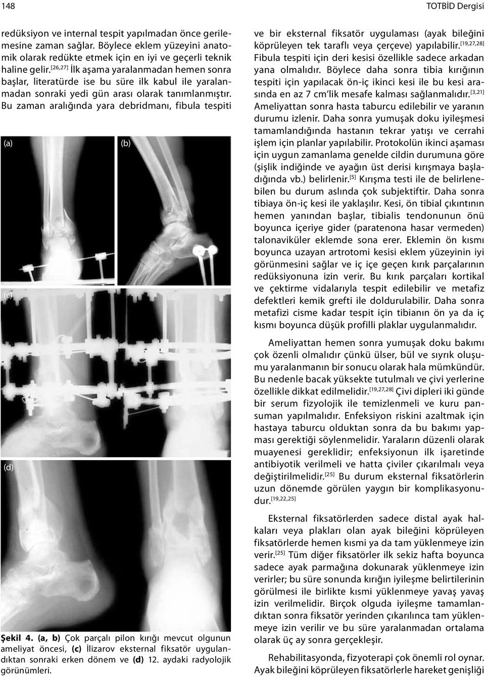 Bu zaman aralığında yara debridmanı, fibula tespiti (a) (c) (d) (b) Şekil 4.