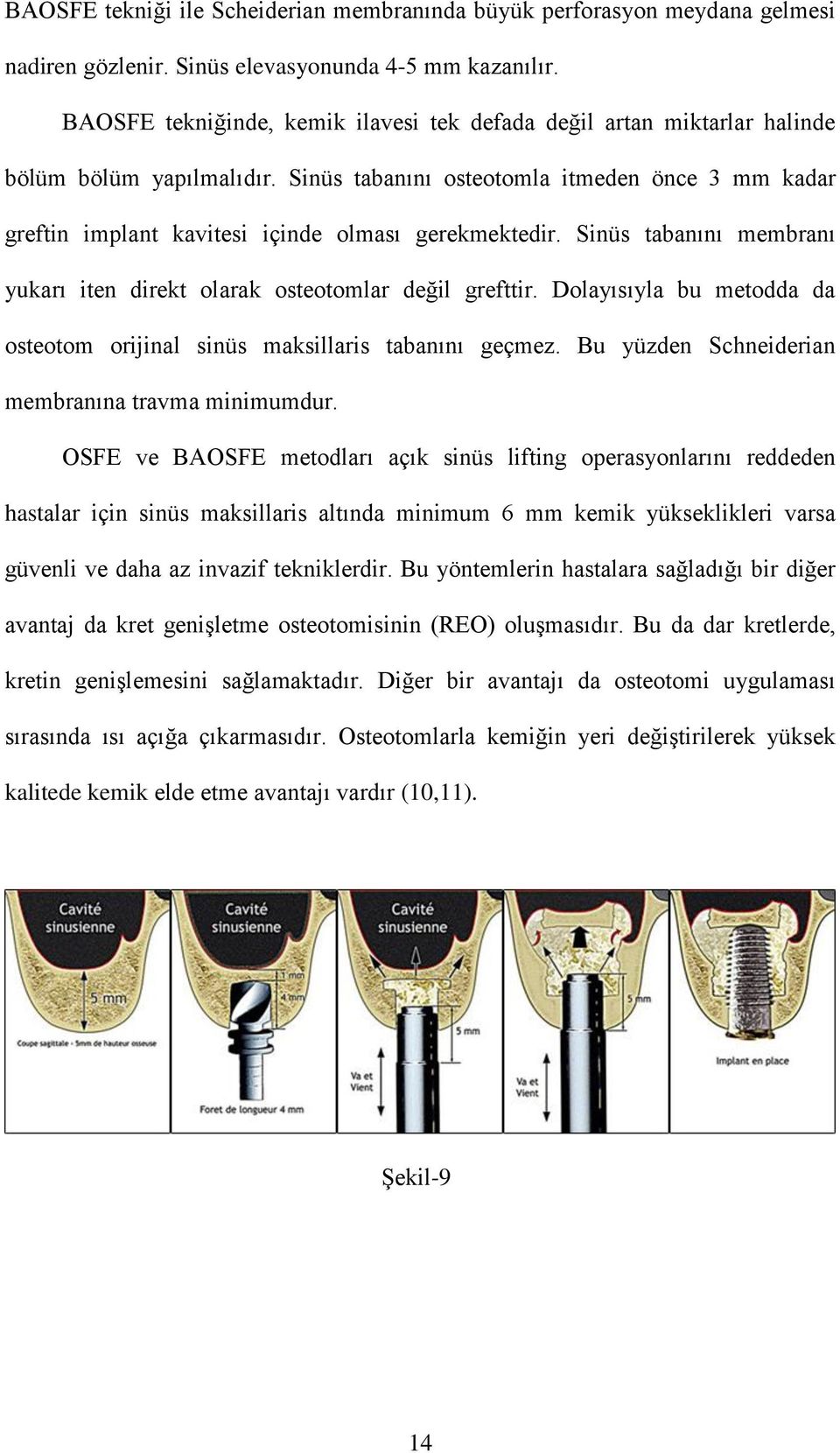 Sinüs tabanını osteotomla itmeden önce 3 mm kadar greftin implant kavitesi içinde olması gerekmektedir. Sinüs tabanını membranı yukarı iten direkt olarak osteotomlar değil grefttir.