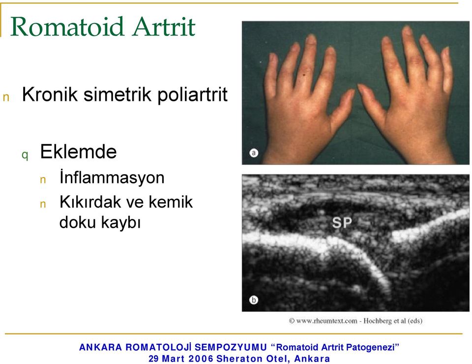 Eklemde İnflammasyon