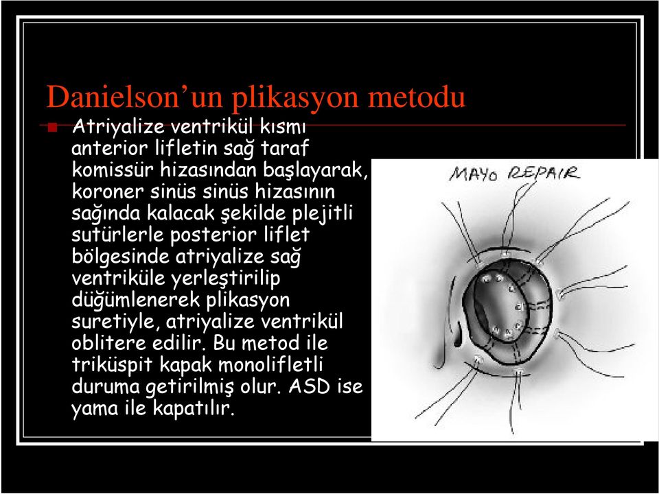 bölgesinde atriyalize sağ ventriküle yerleştirilip düğümlenerek plikasyon suretiyle, atriyalize ventrikül