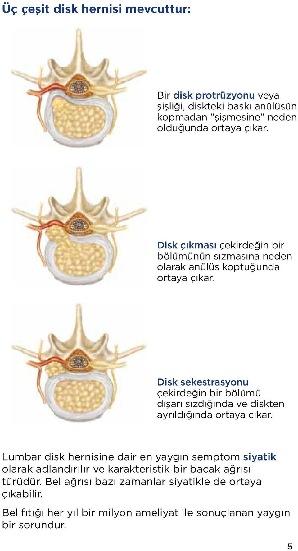 Disk sekestrasyonu çekirdeğin bir bölümü dışarı sızdığında ve diskten ayrıldığında ortaya çıkar.