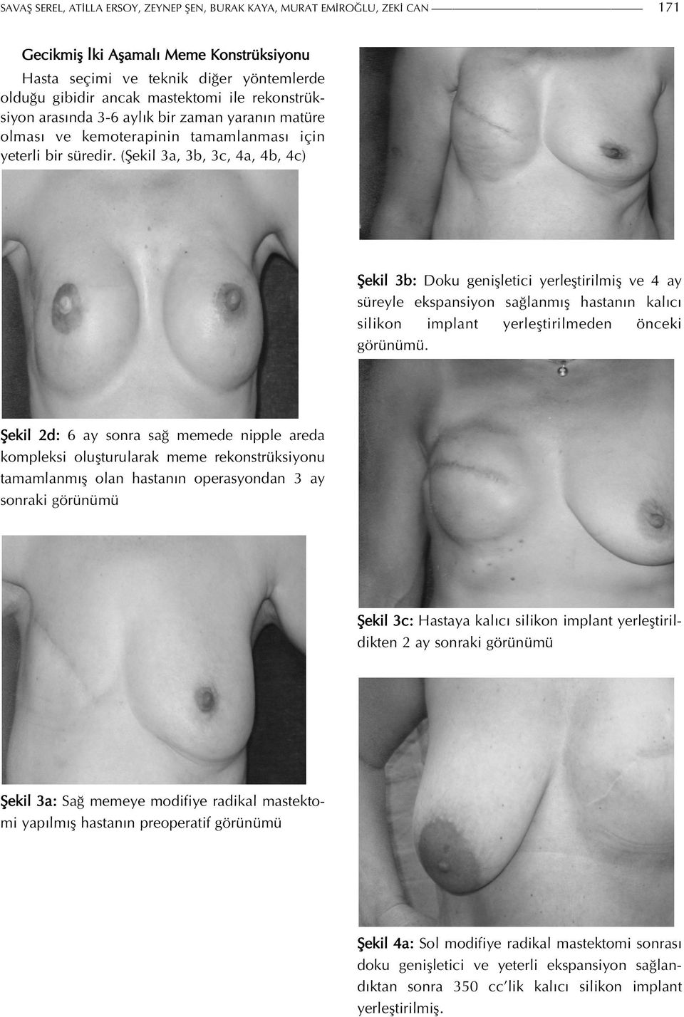 (Şekil 3a, 3b, 3c, 4a, 4b, 4c) Şekil 3b: Doku genişletici yerleştirilmiş ve 4 ay süreyle ekspansiyon sağlanmış hastanın kalıcı silikon implant yerleştirilmeden önceki görünümü.