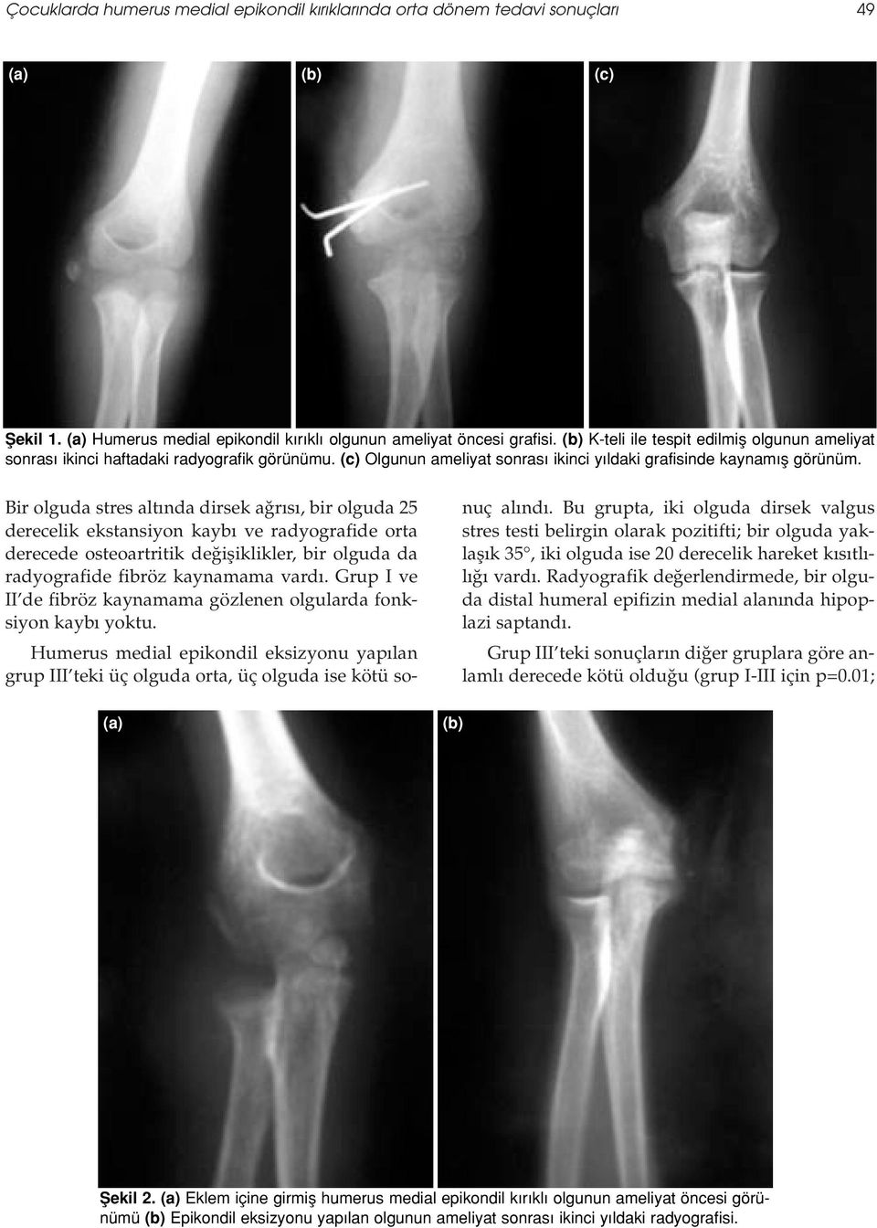 (a) (b) Bir olguda stres alt nda dirsek a r s, bir olguda 25 derecelik ekstansiyon kayb ve radyografide orta derecede osteoartritik de ifliklikler, bir olguda da radyografide fibröz kaynamama vard.