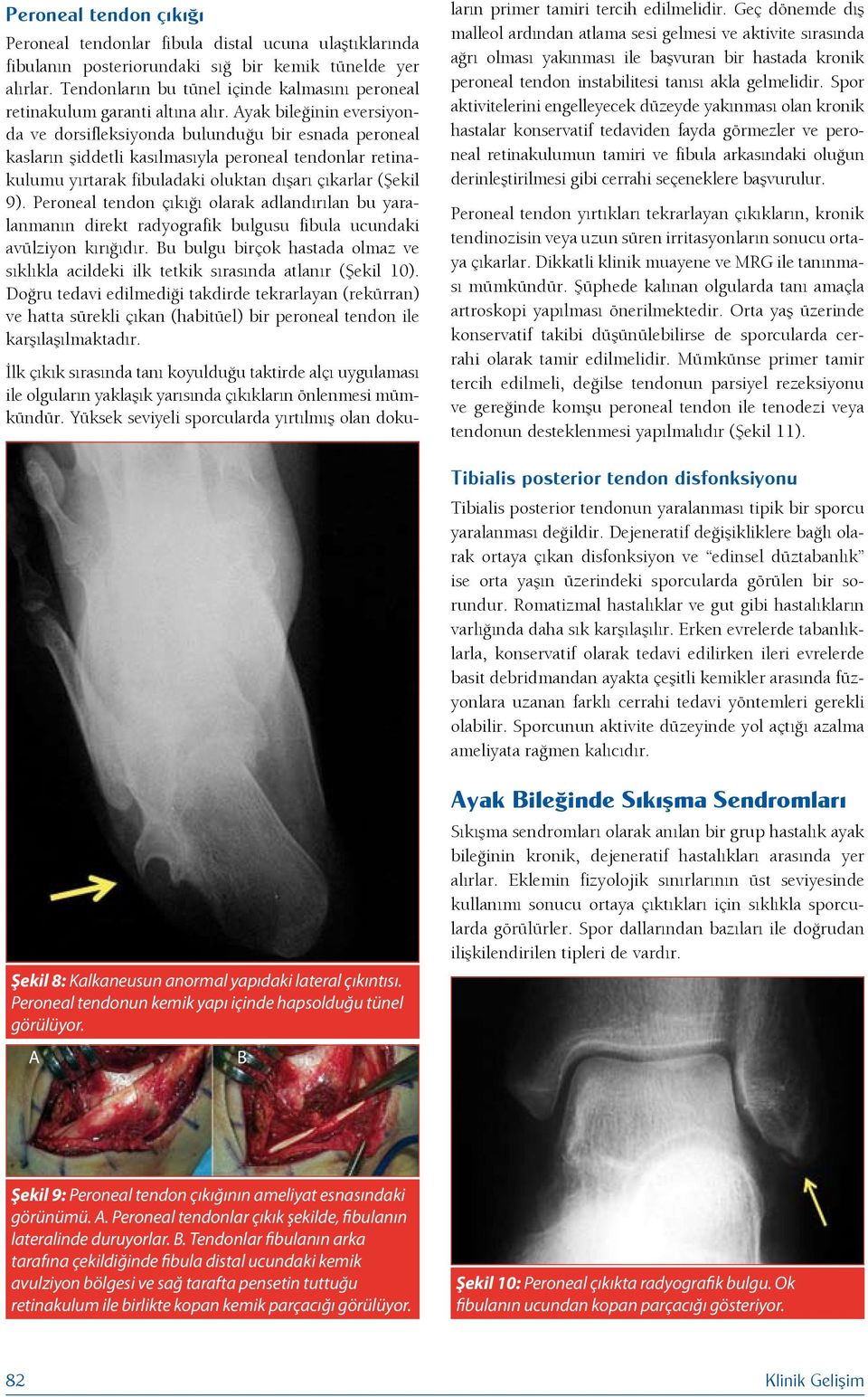 Ayak bileğinin eversiyonda ve dorsifleksiyonda bulunduğu bir esnada peroneal kasların şiddetli kasılmasıyla peroneal tendonlar retinakulumu yırtarak fibuladaki oluktan dışarı çıkarlar (Şekil 9).