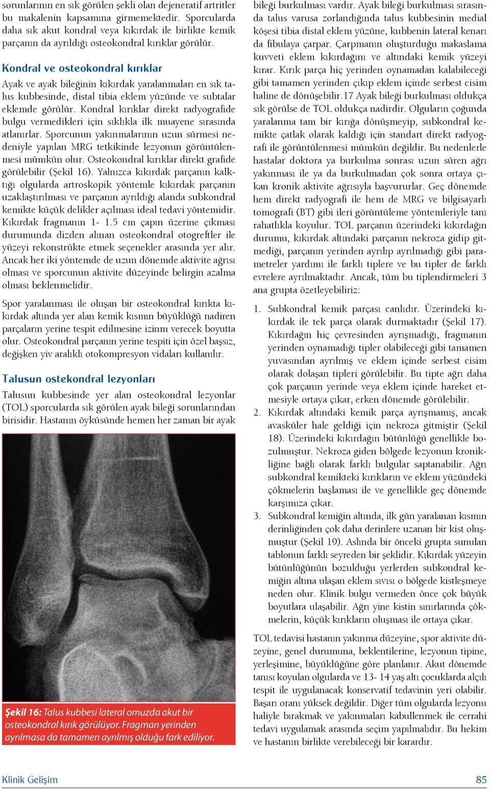 Kondral ve osteokondral kırıklar Ayak ve ayak bileğinin kıkırdak yaralanmaları en sık talus kubbesinde, distal tibia eklem yüzünde ve subtalar eklemde görülür.