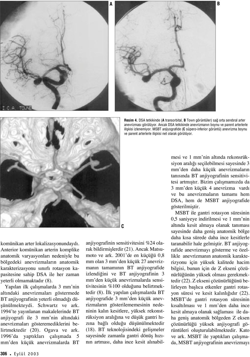 Anterior komünikan arterin komplike anatomik varyasyonlar nedeniyle bu bölgedeki anevrizmalar n anatomik karakterizasyonu s n rl rotasyon kapasitesine sahip DSA ile her zaman yeterli olmamaktad r (8).