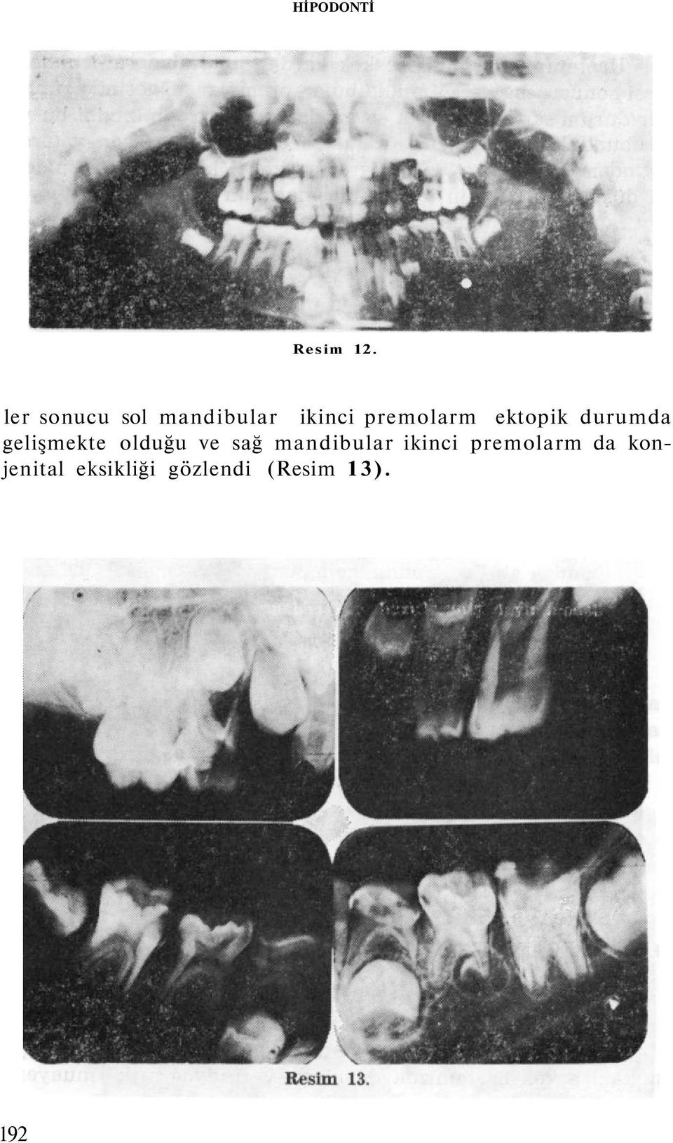 ektopik durumda gelişmekte olduğu ve sağ