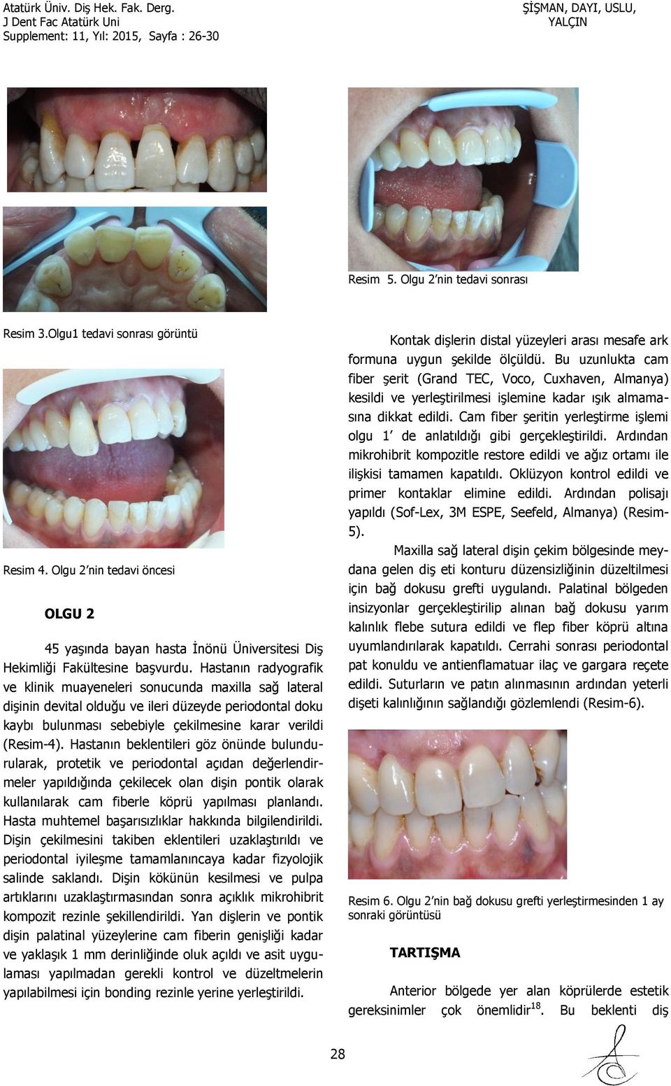 Hastanın beklentileri göz önünde bulundurularak, protetik ve periodontal açıdan değerlendirmeler yapıldığında çekilecek olan dişin pontik olarak kullanılarak cam fiberle köprü yapılması planlandı.