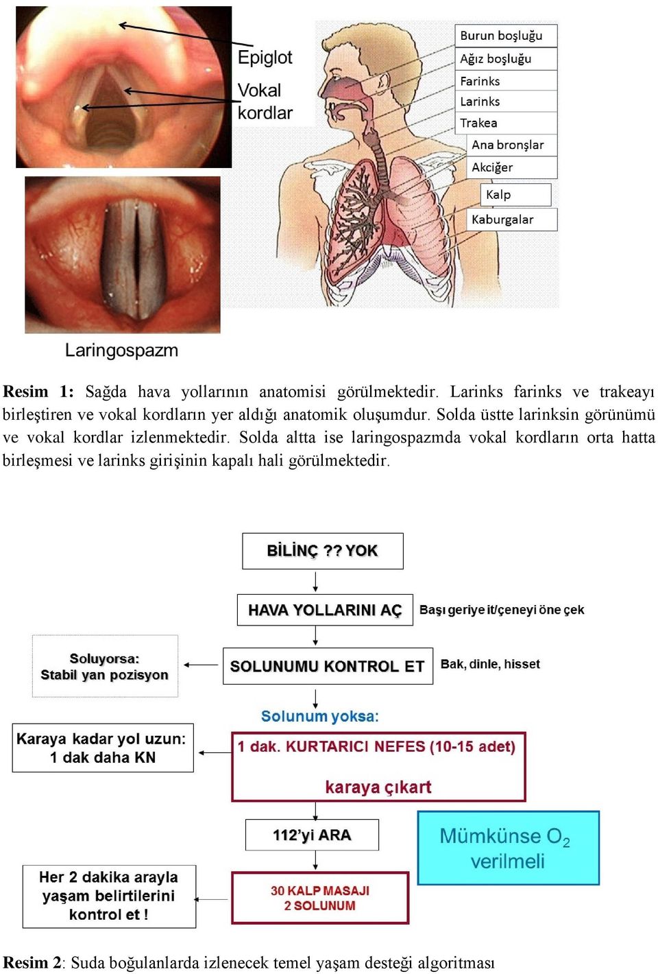 Solda üstte larinksin görünümü ve vokal kordlar izlenmektedir.