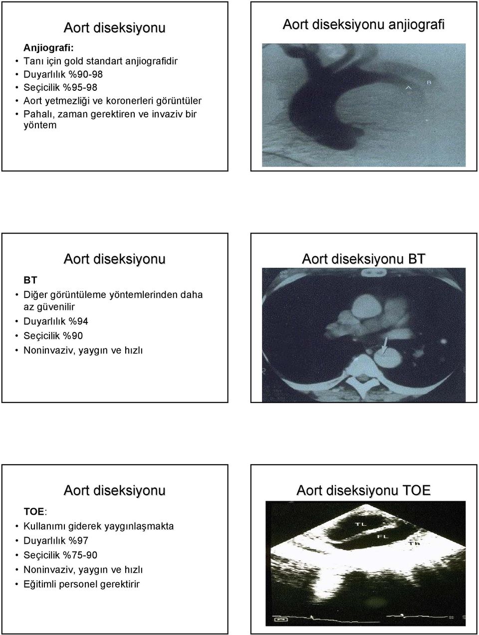 yöntemlerinden daha az güvenilir Duyarlılık %94 Seçicilik %90 Noninvaziv, yaygın ve hızlı Aort diseksiyonu BT Aort diseksiyonu TOE: