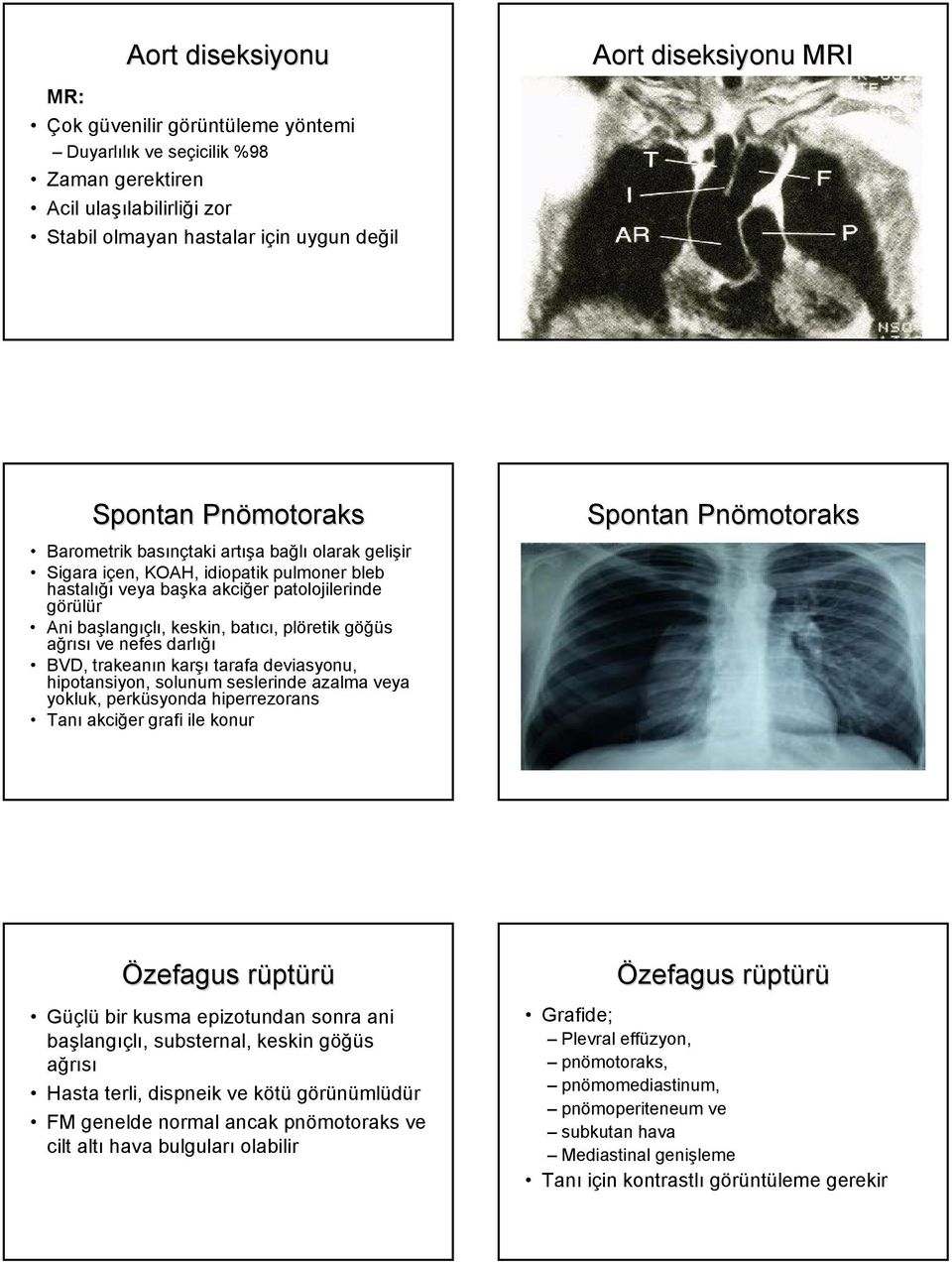 göğüs ağrısı ve nefes darlığı BVD, trakeanın karşı tarafa deviasyonu, hipotansiyon, solunum seslerinde azalma veya yokluk, perküsyonda hiperrezorans Tanı akciğer grafi ile konur Spontan Pnömotoraks
