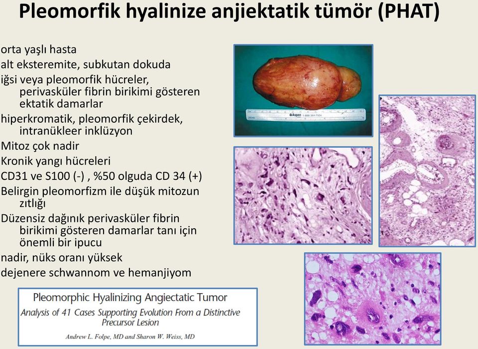 nadir Kronik yangı hücreleri CD31 ve S100 (-), %50 olguda CD 34 (+) Belirgin pleomorfizm ile düşük mitozun zıtlığı Düzensiz