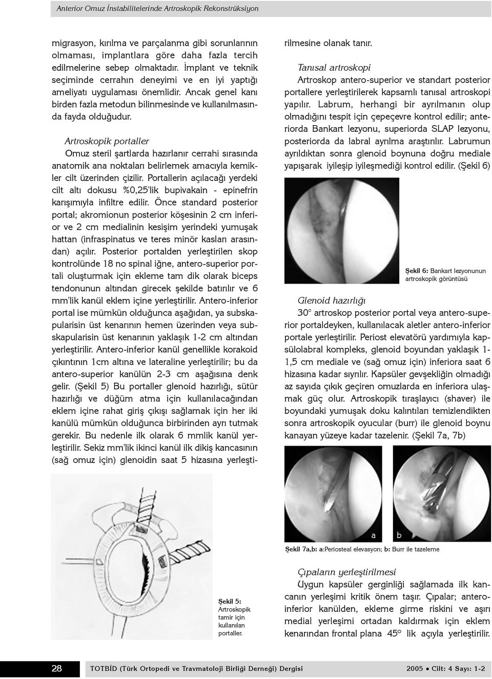 Artroskopik portaller Omuz steril þartlarda hazýrlanýr cerrahi sýrasýnda anatomik ana noktalarý belirlemek amacýyla kemikler cilt üzerinden çizilir.