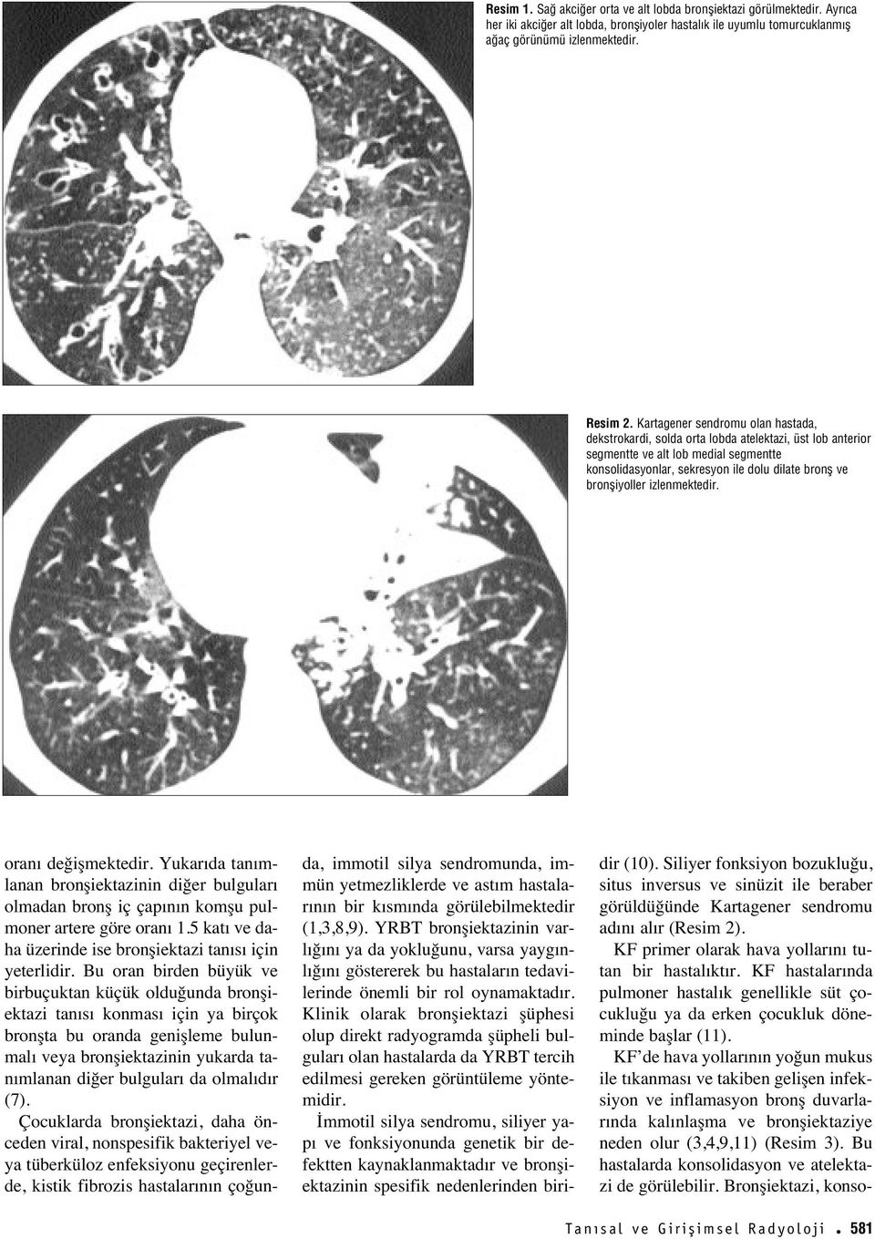 izlenmektedir. oran değişmektedir. Yukar da tan mlanan bronşiektazinin diğer bulgular olmadan bronş iç çap n n komşu pulmoner artere göre oran 1.