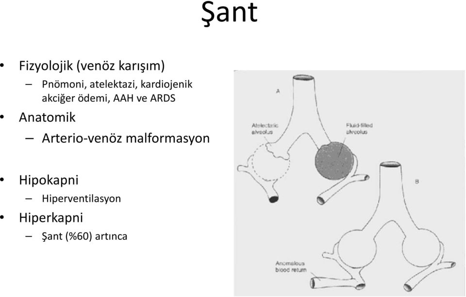 ARDS Anatomik Arterio-venöz malformasyon