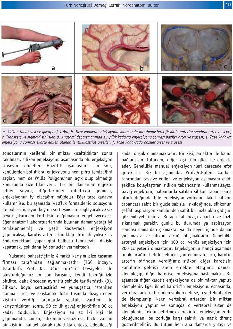 Taze kadavra enjeksiyonu sonras ekarte edilen alanda lentikülostriat arterler, f.