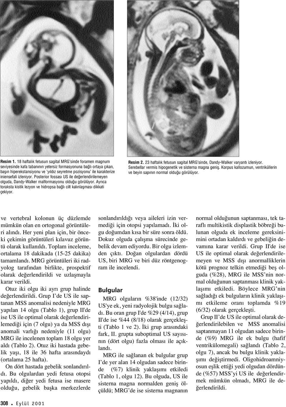 iniensefali izleniyor. Posterior fossas US ile de erlendirilemeyen olguda, Dandy-Walker malformasyonu oldu u görülüyor.