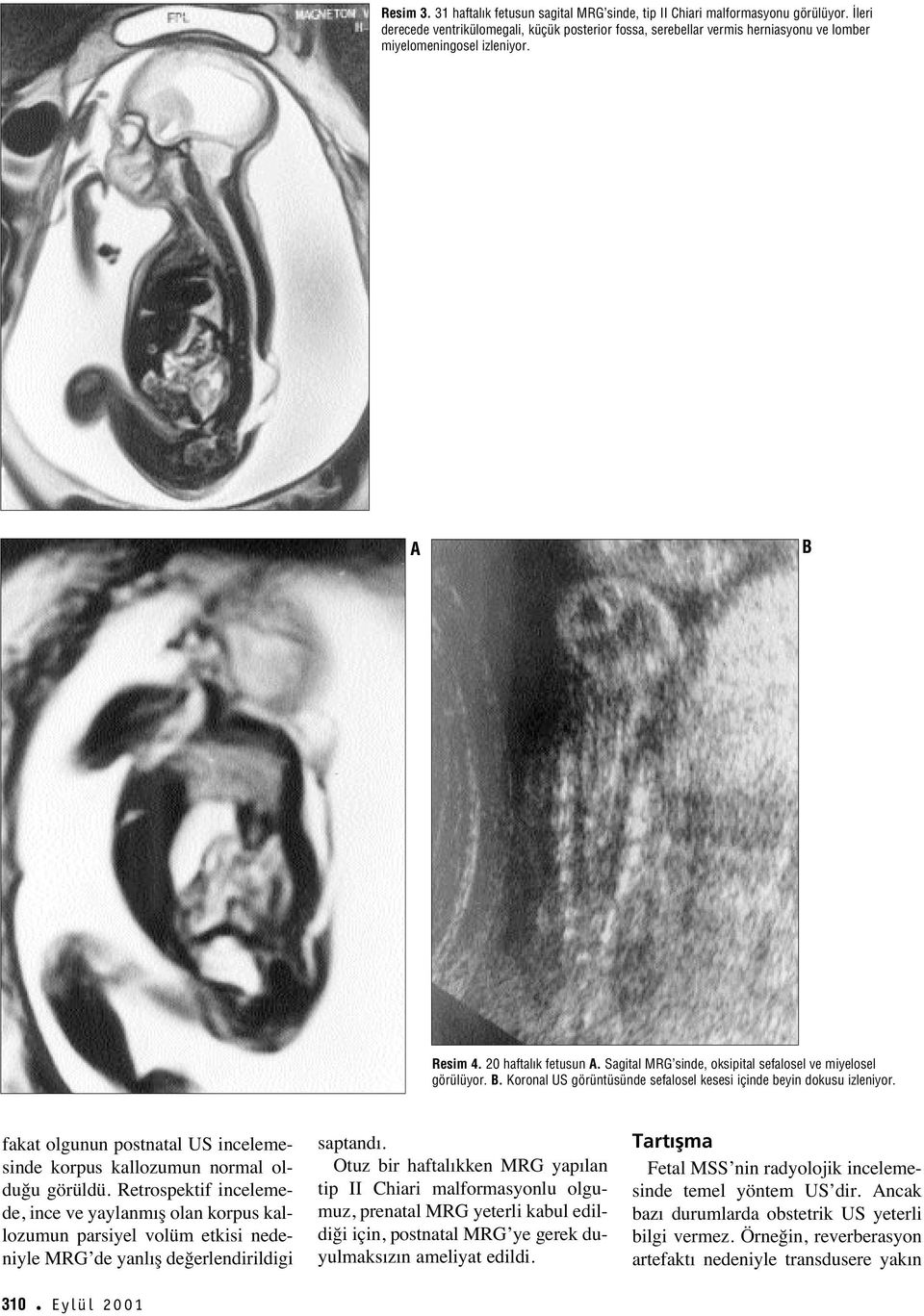 Sagital MRG sinde, oksipital sefalosel ve miyelosel görülüyor. B. Koronal US görüntüsünde sefalosel kesesi içinde beyin dokusu izleniyor.