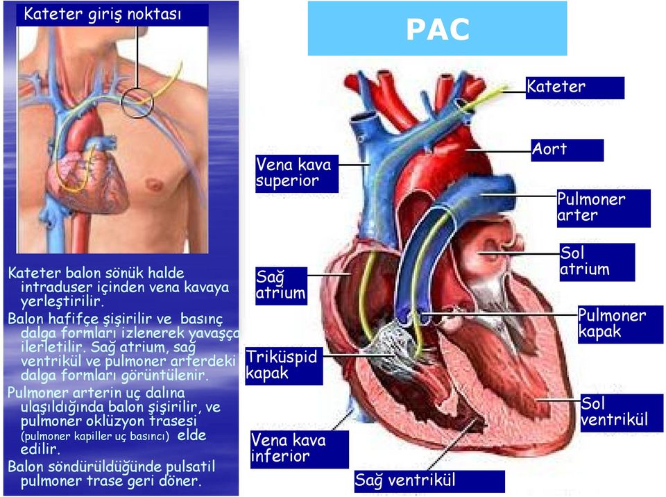 Sağ atrium, sağ ventrikül ve pulmoner arterdeki dalga formları görüntülenir.