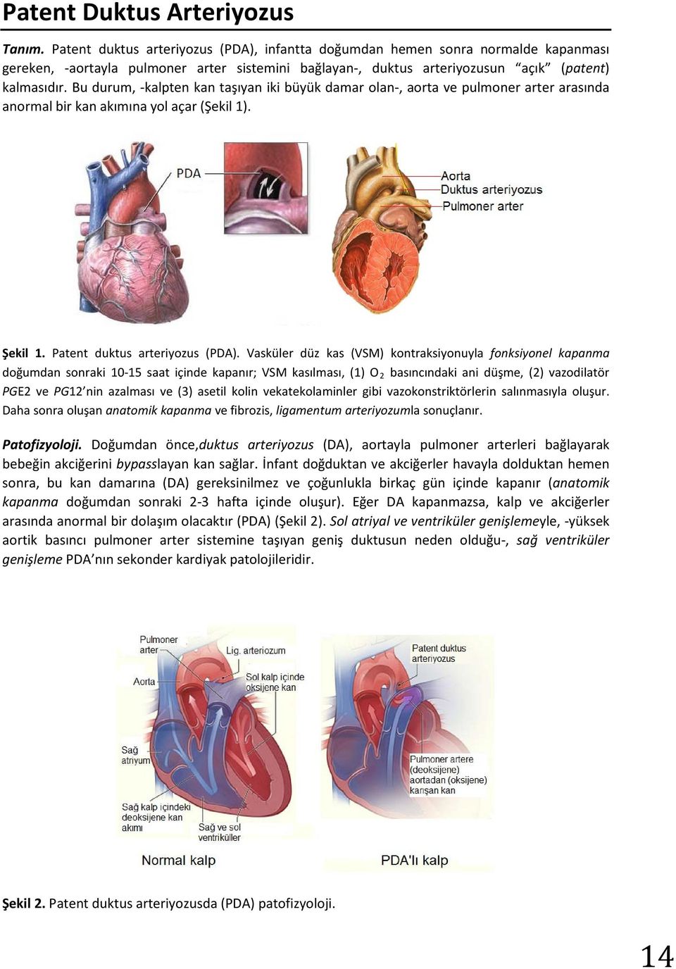 Bu durum, -kalpten kan taşıyan iki büyük damar olan-, aorta ve pulmoner arter arasında anormal bir kan akımına yol açar (Şekil 1). Şekil 1. Patent duktus arteriyozus (PDA).