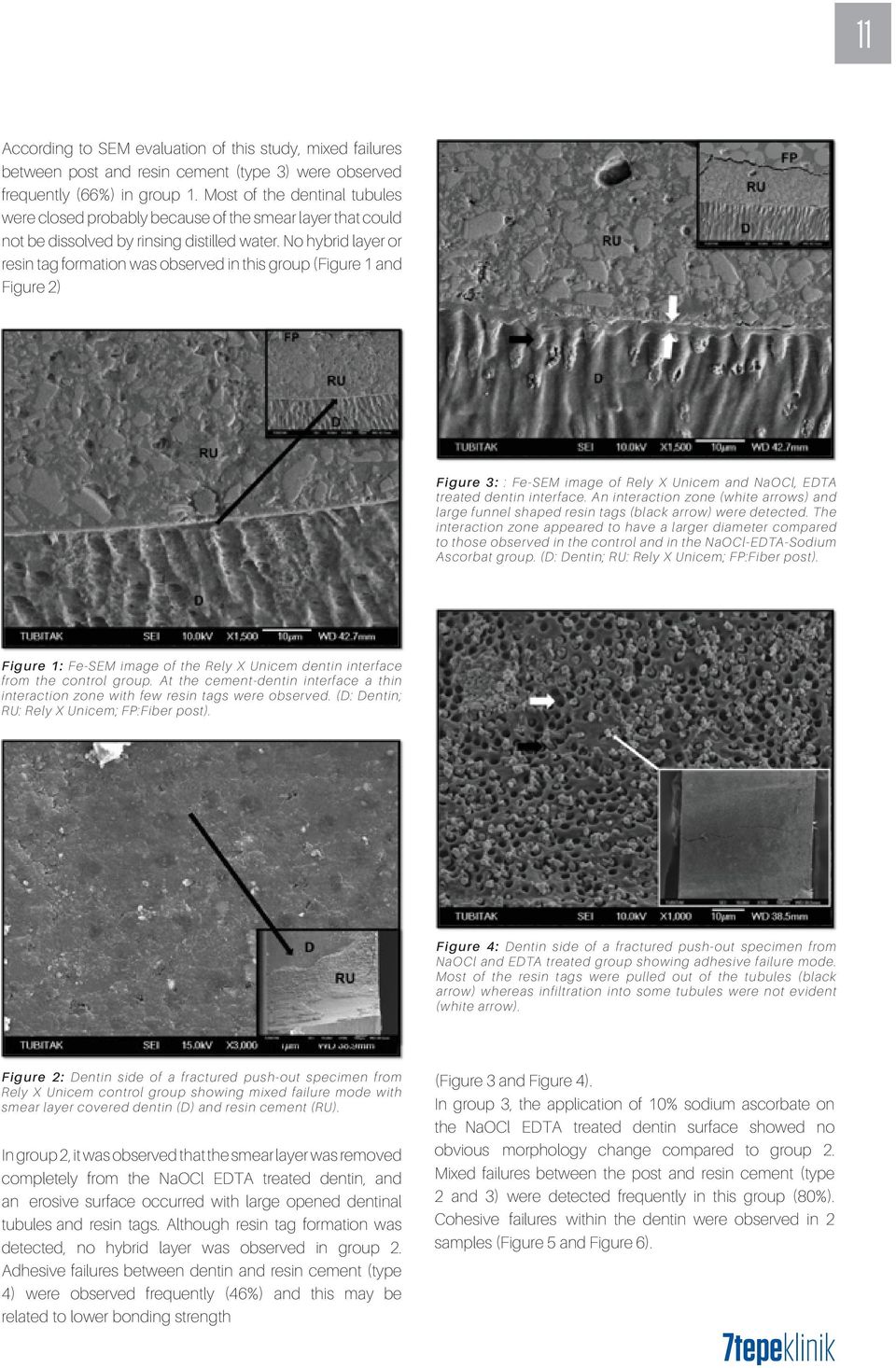 No hybrid layer or resin tag formation was observed in this group (Figure 1 and Figure 2) Figure 3: : Fe-SEM image of Rely X Unicem and NaOCl, EDTA treated dentin interface.