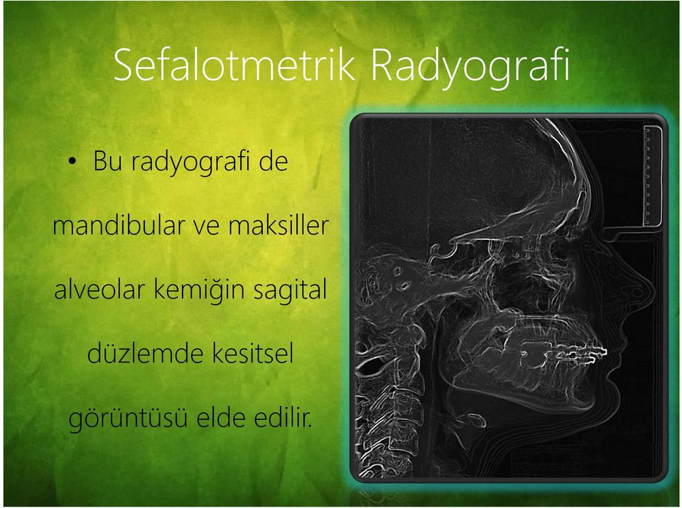 maksiller alveolar kemiğin