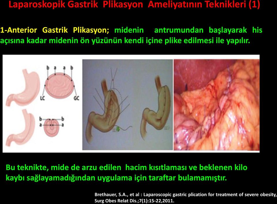 Bu teknikte, mide de arzu edilen hacim kısıtlaması ve beklenen kilo kaybı sağlayamadığından uygulama için