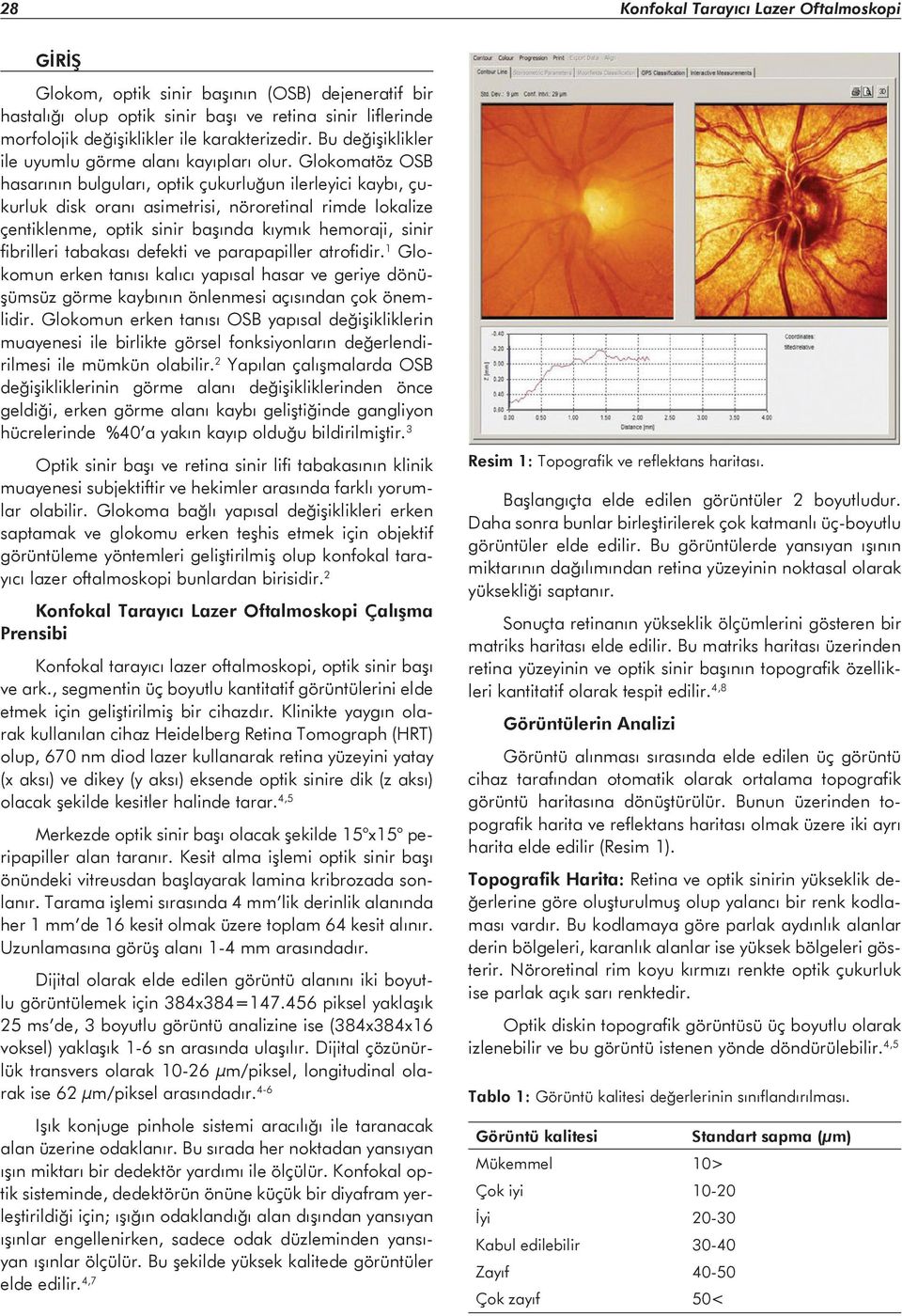 Glokomatöz OSB hasarının bulguları, optik çukurluğun ilerleyici kaybı, çukurluk disk oranı asimetrisi, nöroretinal rimde lokalize çentiklenme, optik sinir başında kıymık hemoraji, sinir fibrilleri