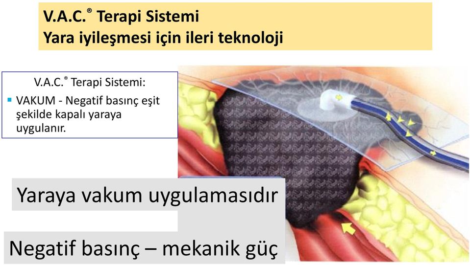 teknoloji  Terapi Sistemi: VAKUM - Negatif