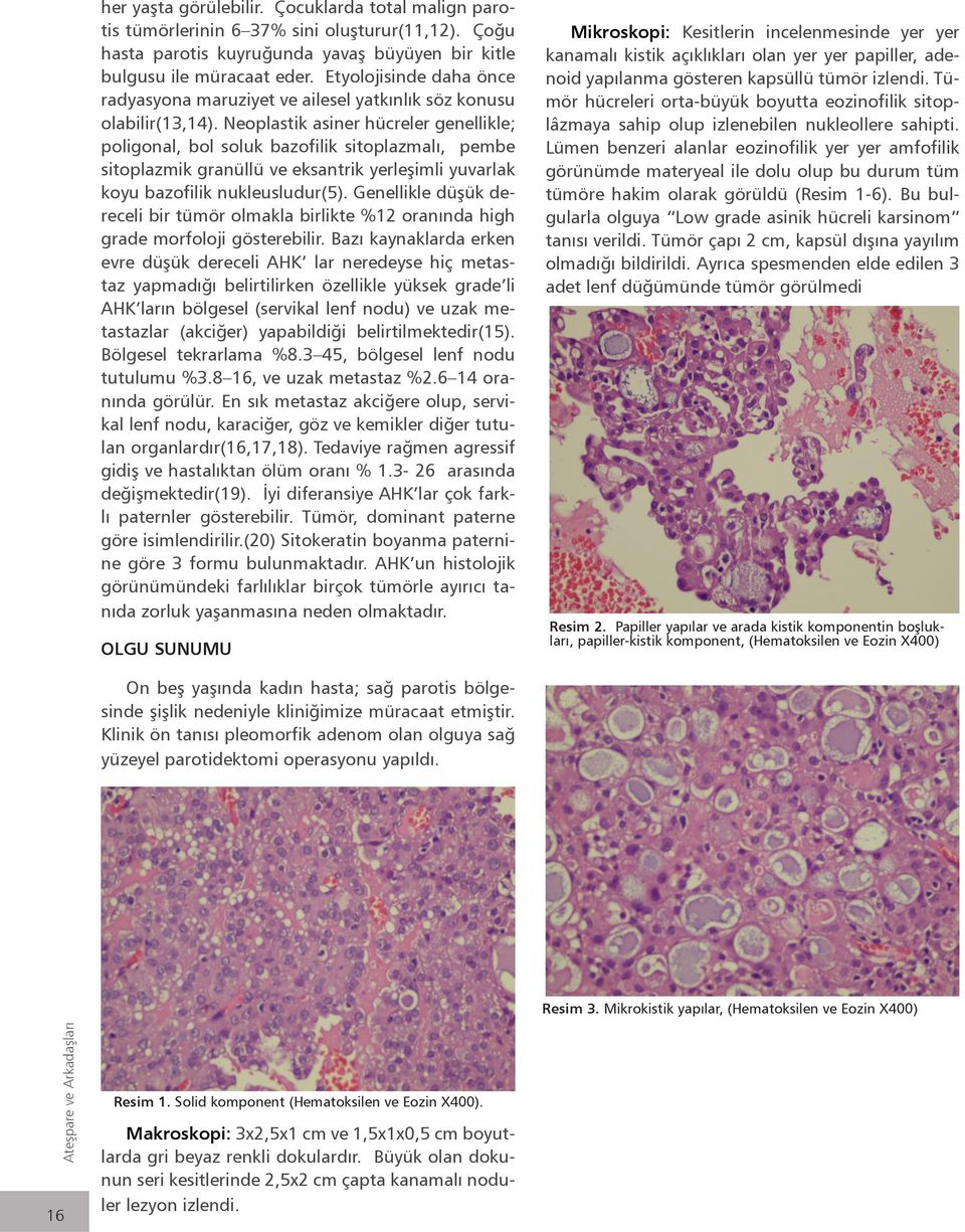 Neoplastik asiner hücreler genellikle; poligonal, bol soluk bazofilik sitoplazmalı, pembe sitoplazmik granüllü ve eksantrik yerleşimli yuvarlak koyu bazofilik nukleusludur(5).