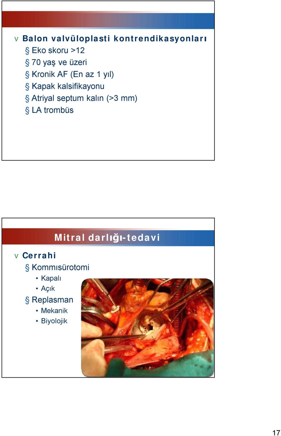 Atriyal septum kalın (>3 mm) LA trombüs vcerrahi