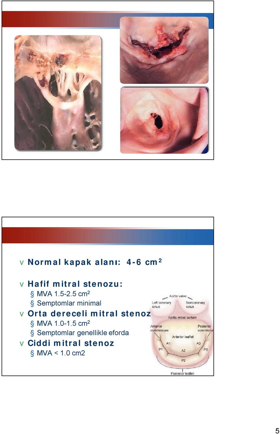 5 cm 2 Semptomlar minimal vorta dereceli mitral