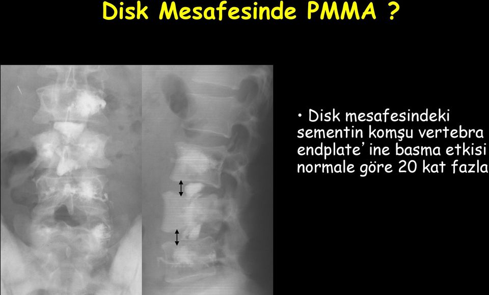 komşu vertebra endplate ine