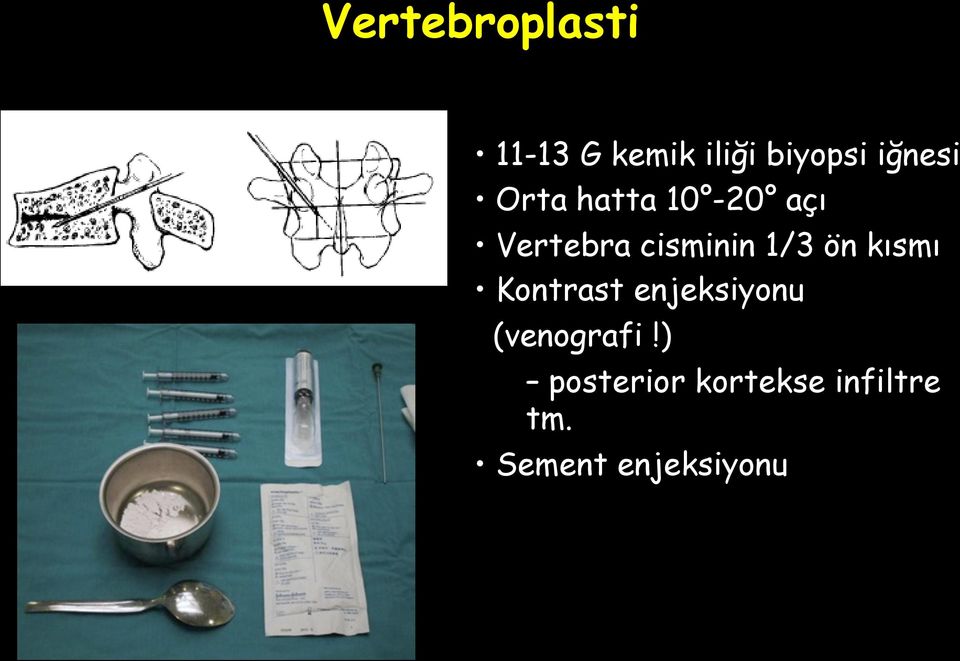 1/3 ön kısmı Kontrast enjeksiyonu (venografi!