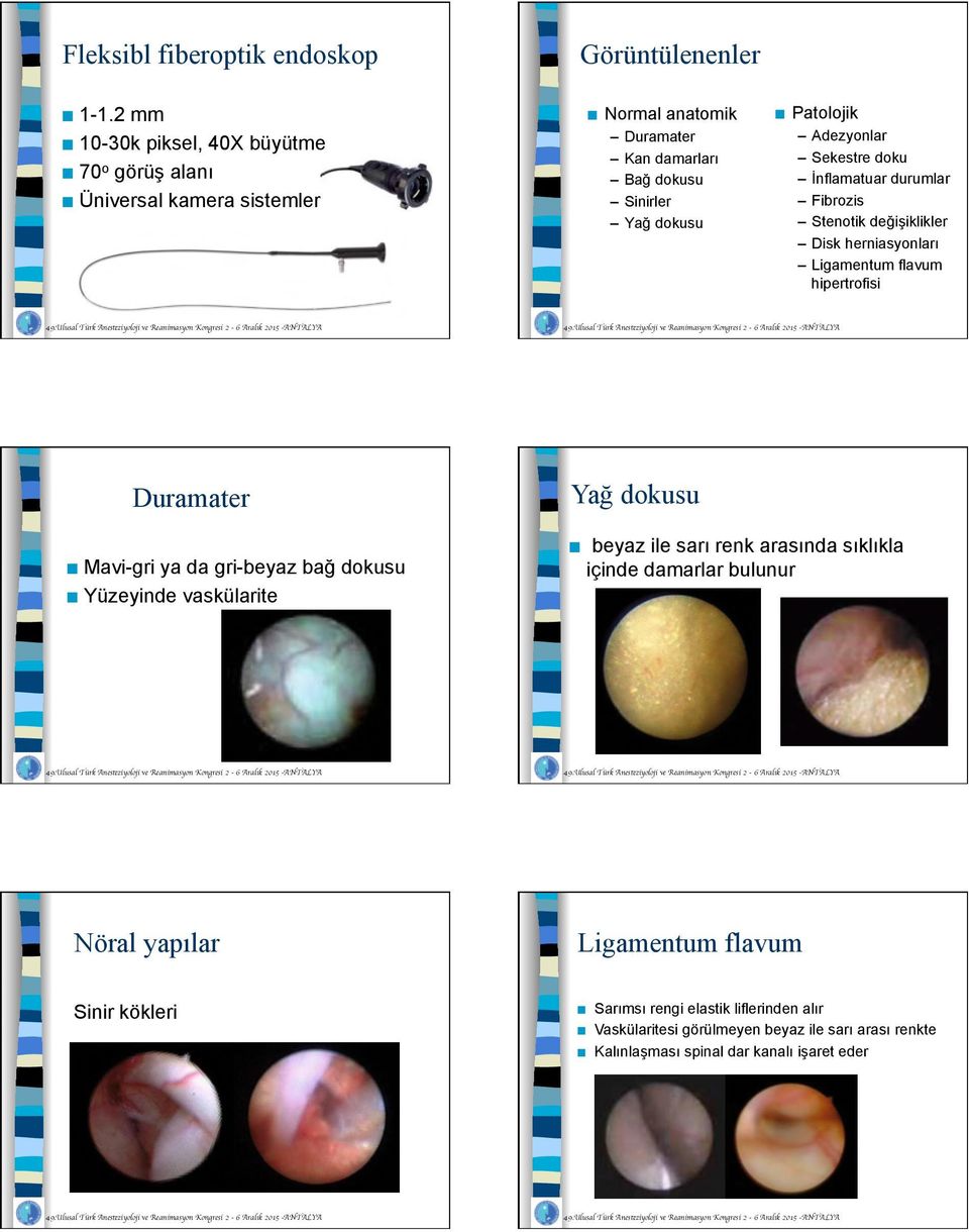 Adezyonlar Sekestre doku İnflamatuar durumlar Fibrozis Stenotik değişiklikler Disk herniasyonları Ligamentum flavum hipertrofisi Duramater Mavi-gri ya da gri-beyaz