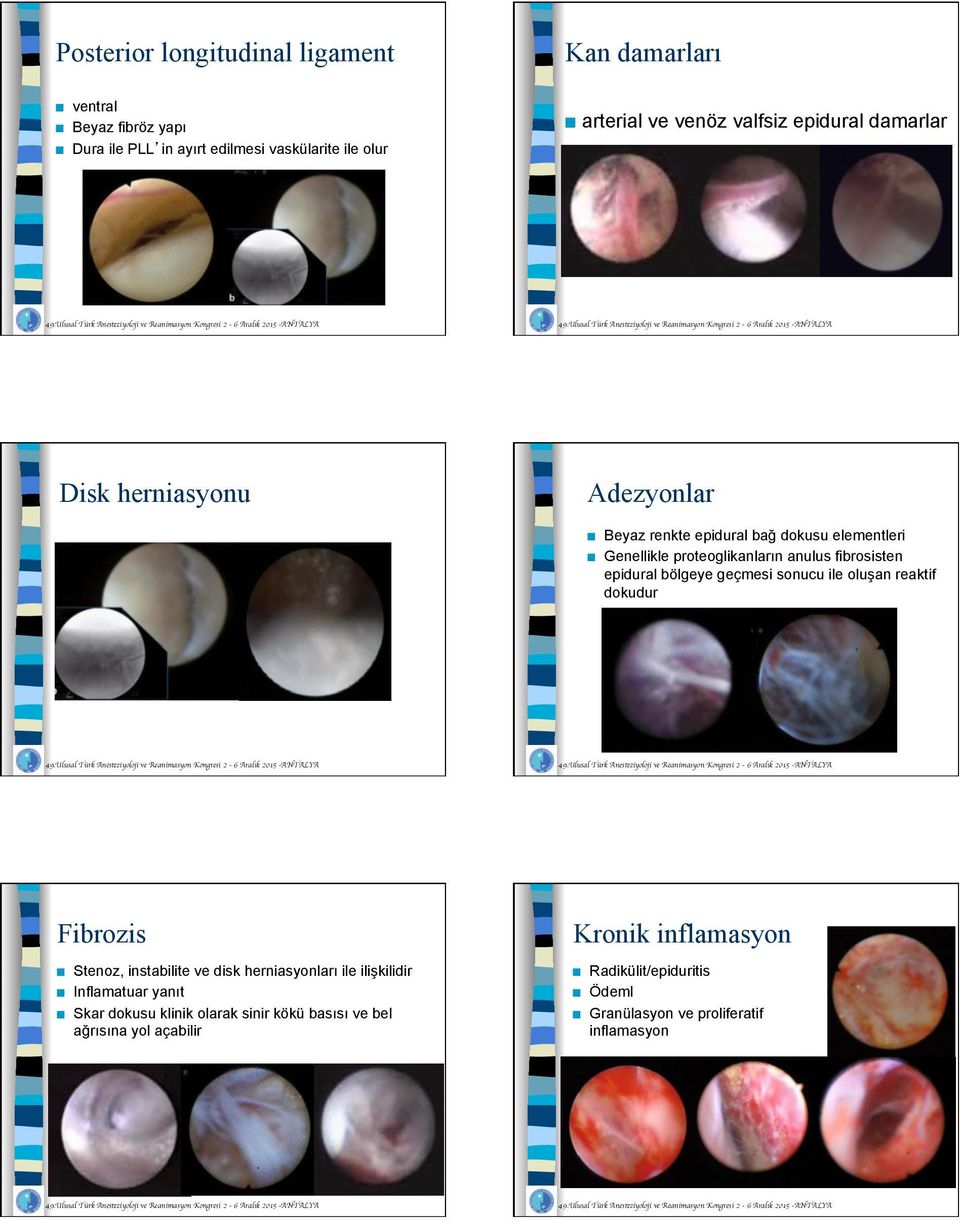 epidural bölgeye geçmesi sonucu ile oluşan reaktif dokudur Fibrozis Stenoz, instabilite ve disk herniasyonları ile ilişkilidir Inflamatuar yanıt