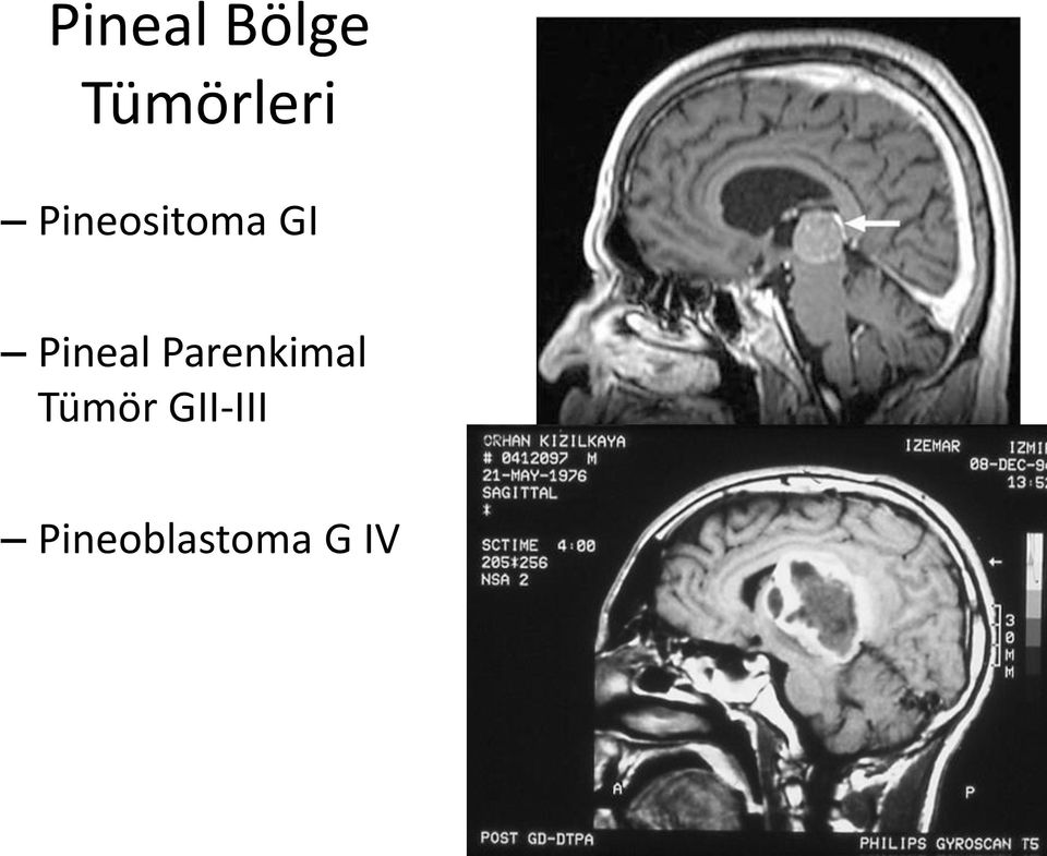 GI Pineal Parenkimal