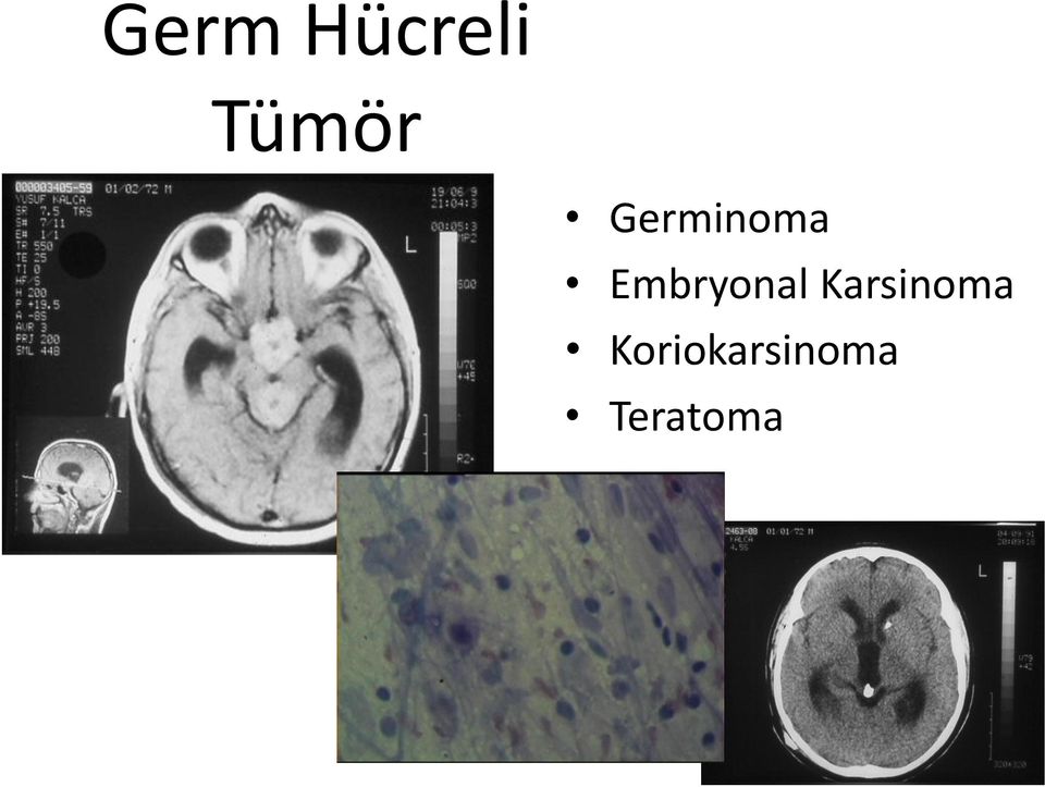 Embryonal