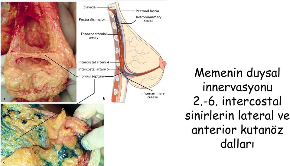 intercostal sinirlerin