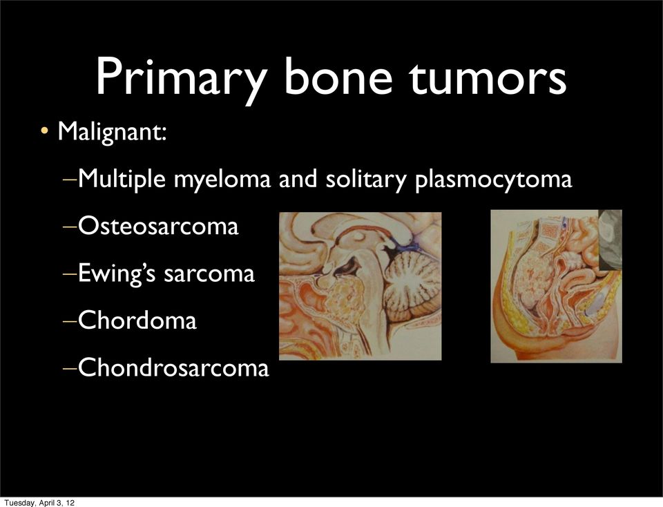 plasmocytoma Osteosarcoma Ewing