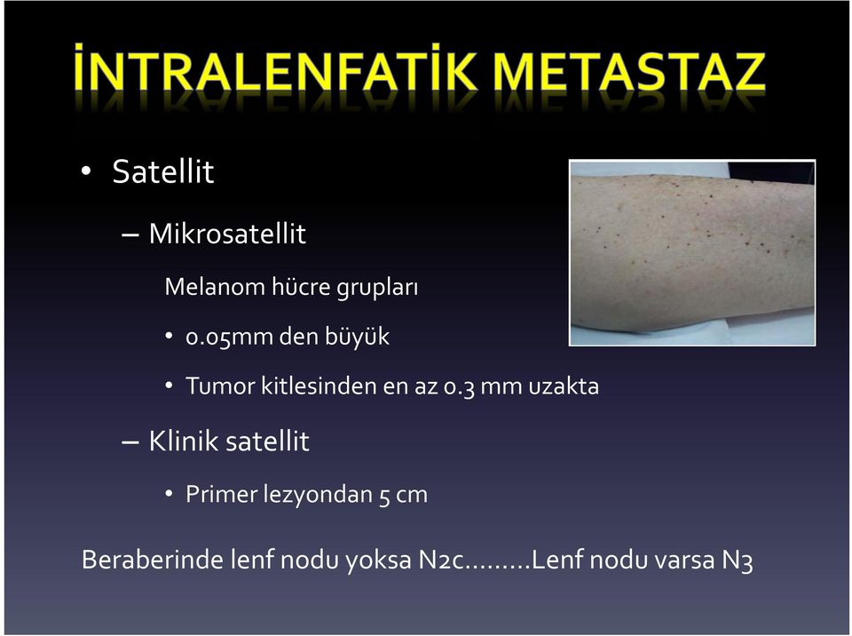 3 mm uzakta Klinik satellit Primer lezyondan 5