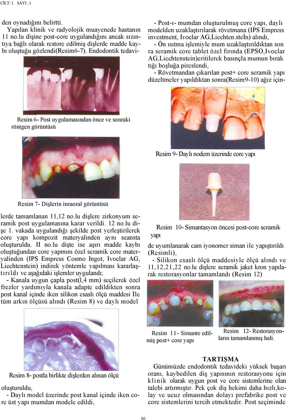 Endodontik tedavi- - Post-ı- mumdan oluşturulmuş core yapı, daylı modelden uzaklaştırılarak rövetmana (IPS Empress investment, Ivoclar AG,Liechten.