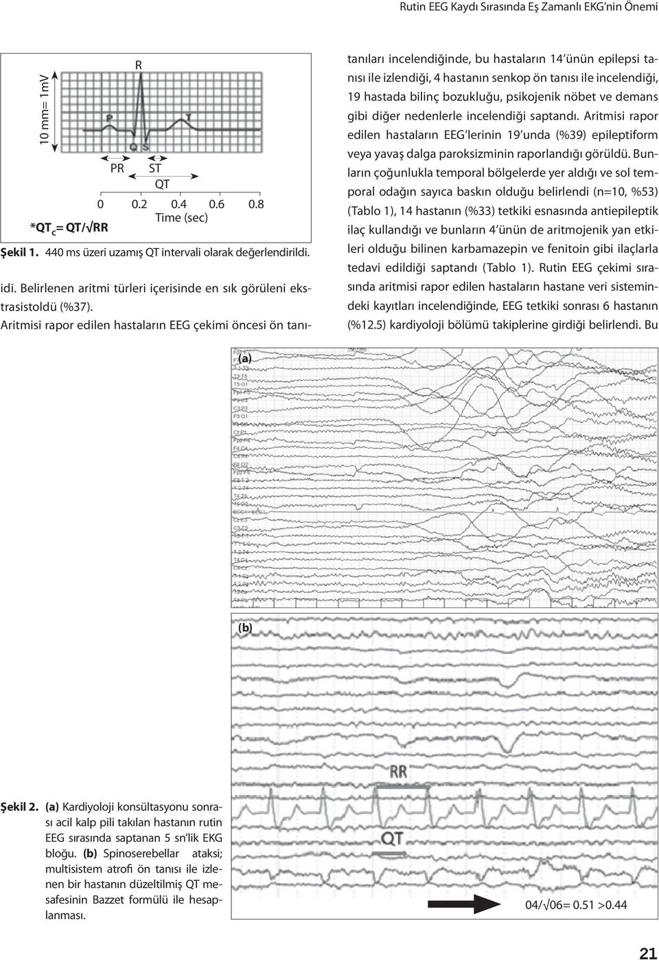 Aritmisi rapor edilen hastaların EEG çekimi öncesi ön tanı- tanıları incelendiğinde, bu hastaların 14 ünün epilepsi tanısı ile izlendiği, 4 hastanın senkop ön tanısı ile incelendiği, 19 hastada