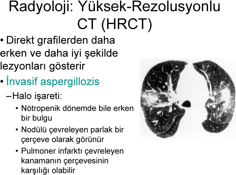 Nötropenik dönemde bile erken bir bulgu Nodülü çevreleyen parlak bir çerçeve